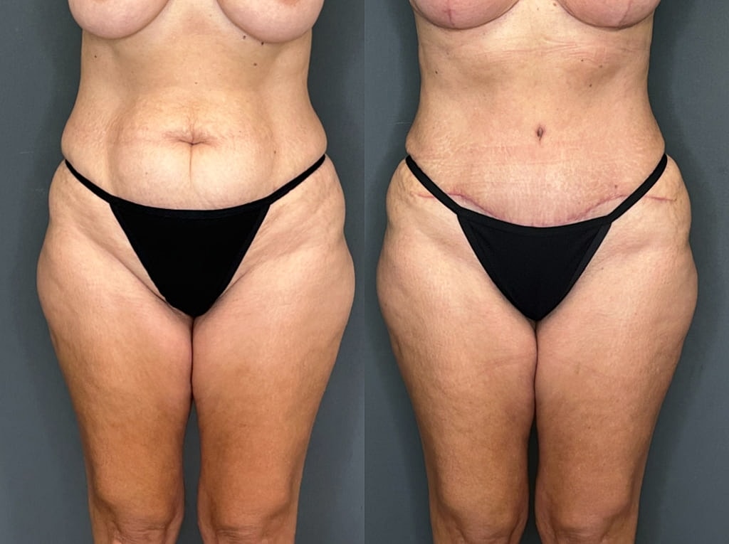 Tummy Tuck Before & After