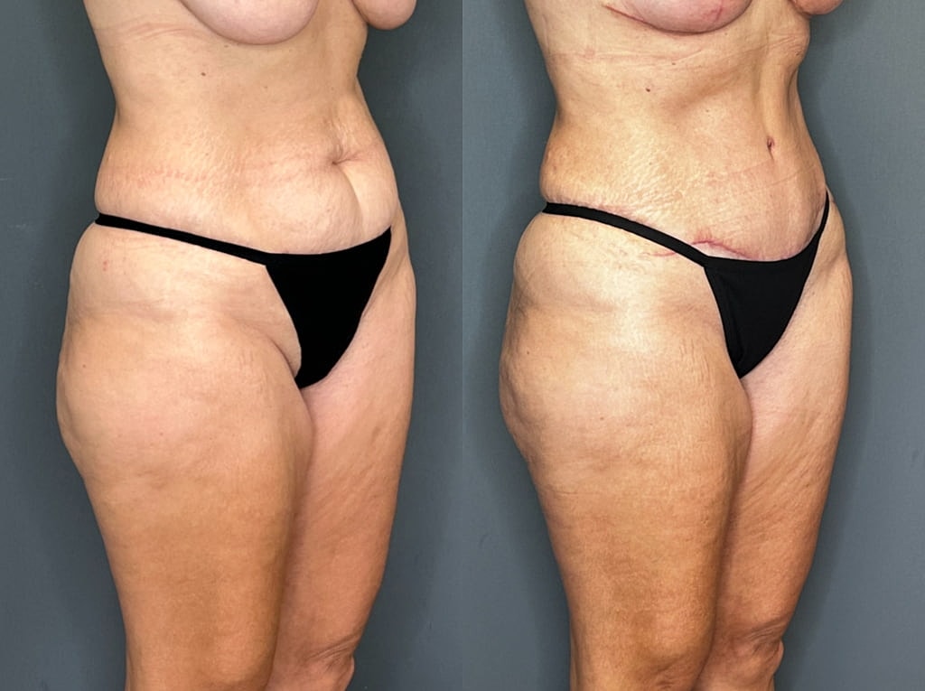 Tummy Tuck Before & After