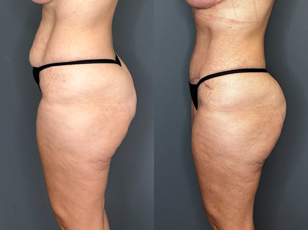 Tummy Tuck Before & After