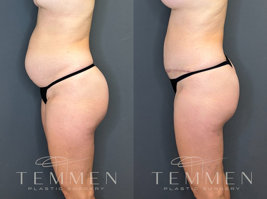 Tummy Tuck Before & After