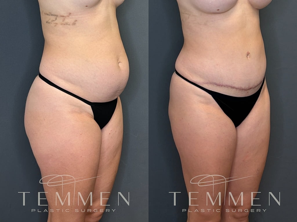 Tummy Tuck Before & After