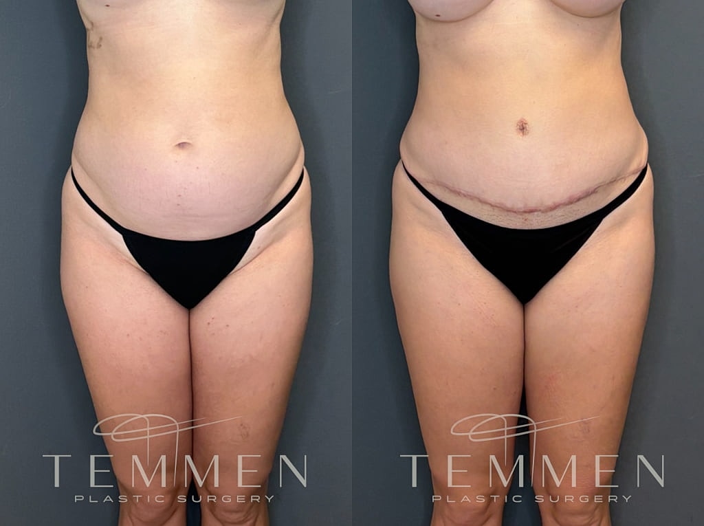 Tummy Tuck Before & After