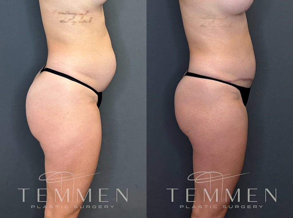 Tummy Tuck Before & After
