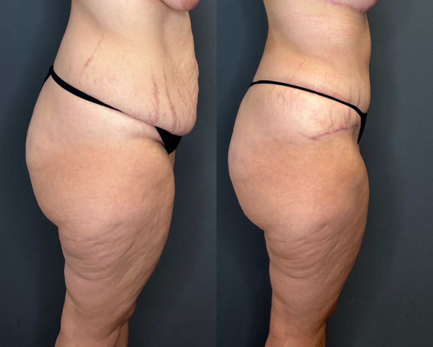 Tummy Tuck Before & After