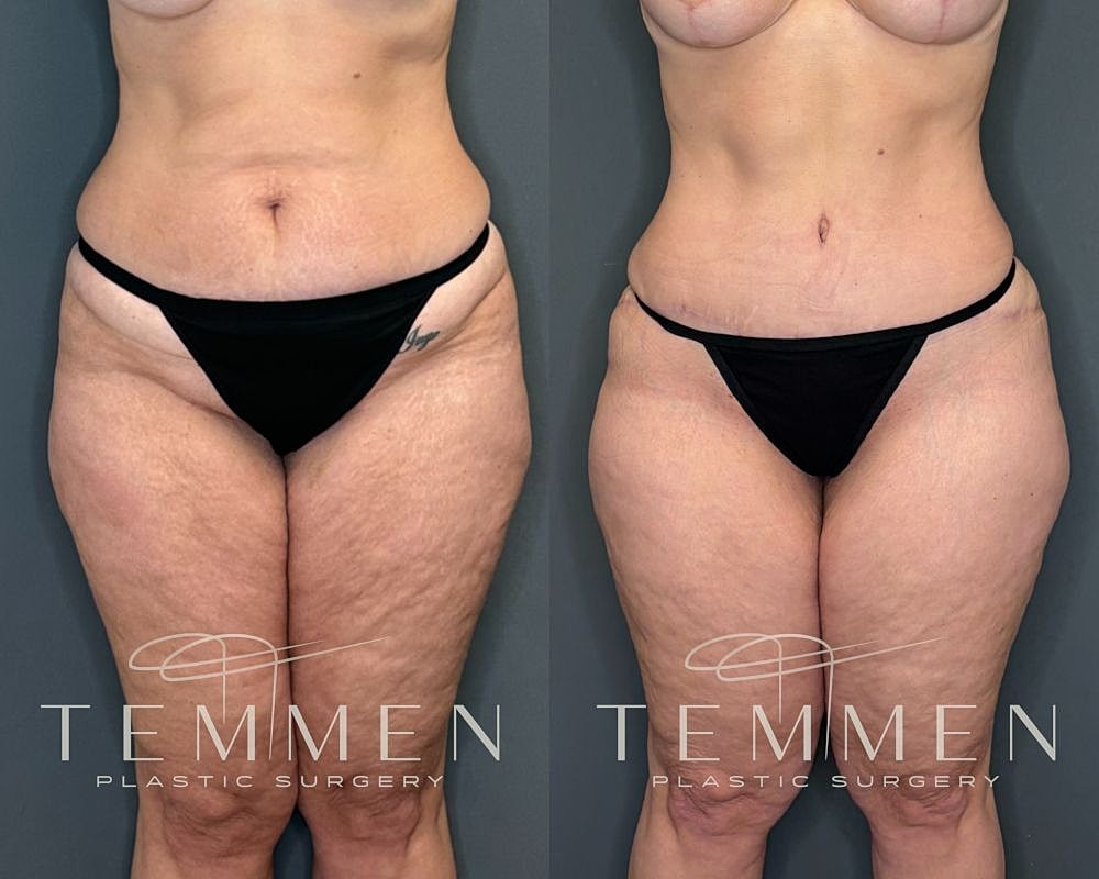 Before and after plastic surgery body transformation.