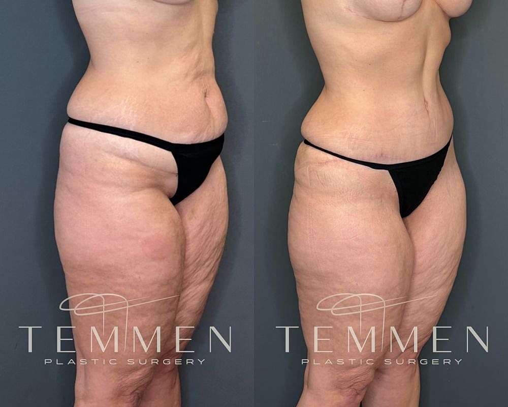 Before and after body contouring surgery comparison.
