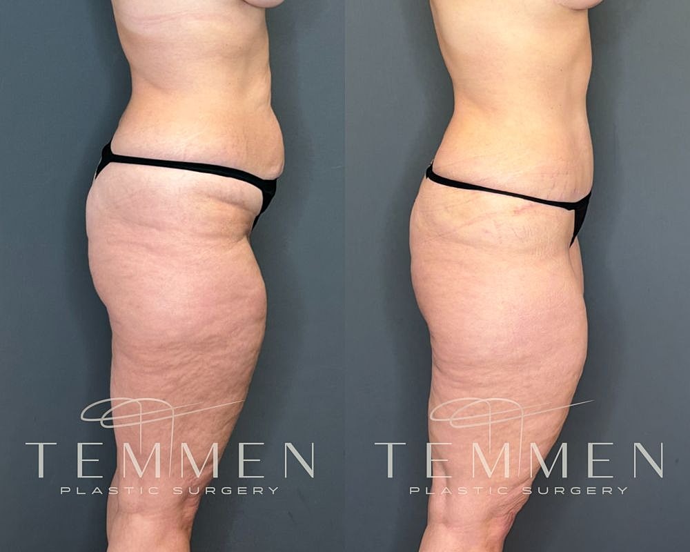 Before and after body contouring treatment comparison.
