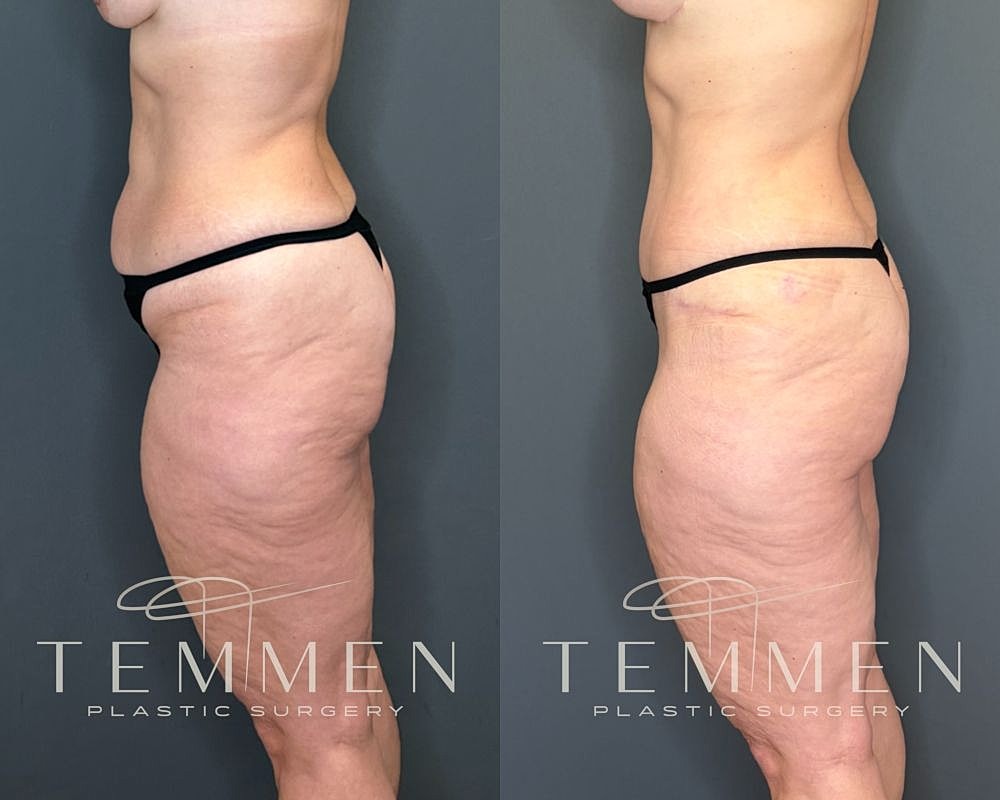 Before and after plastic surgery side view comparison.