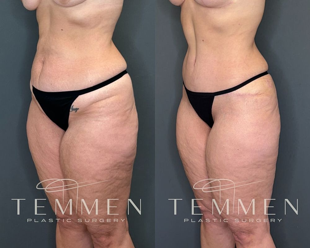 Before and after body contouring surgery results