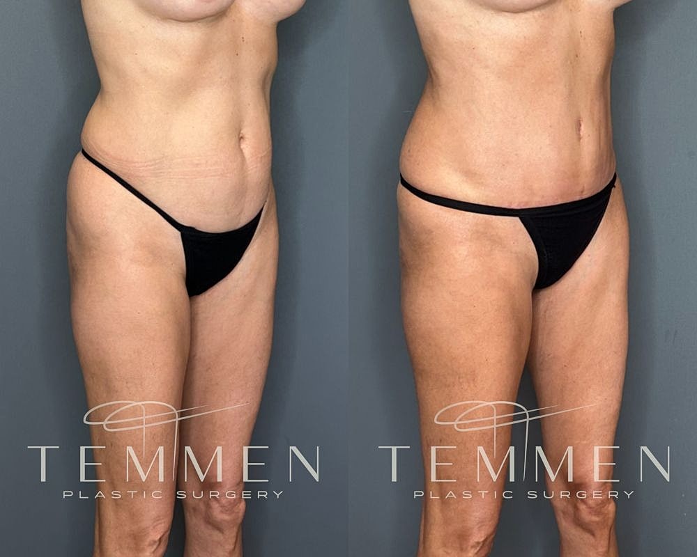 Before and after body contouring procedure images.