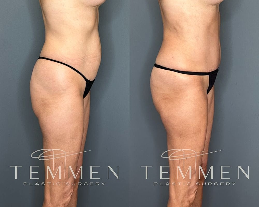 Before and after plastic surgery side view.