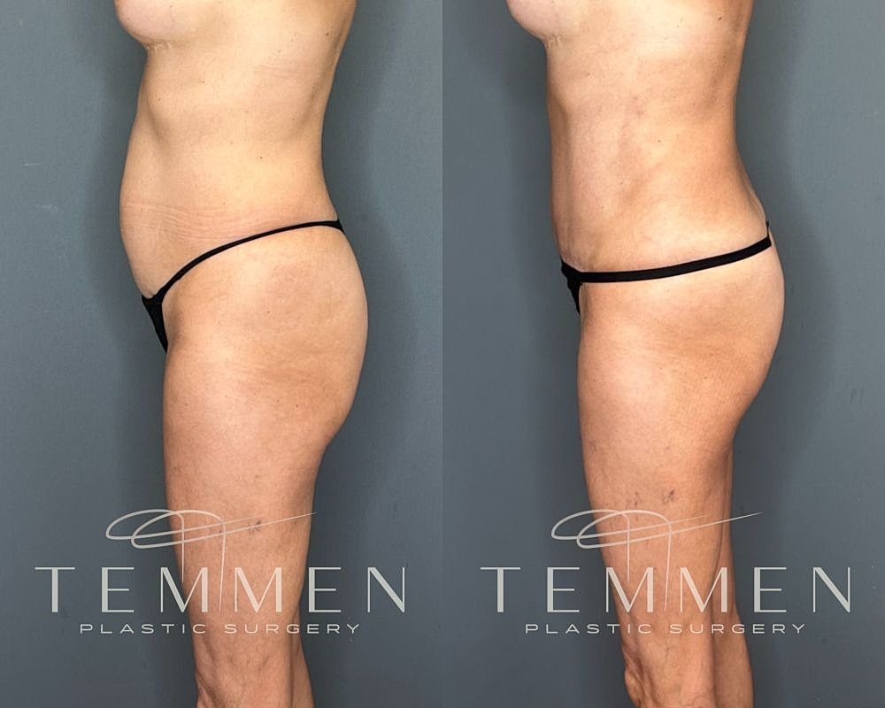 Side profile of body before and after surgery.