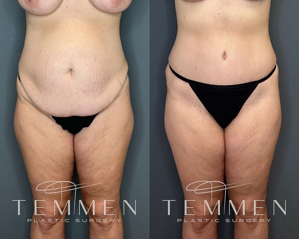 Before and after plastic surgery transformation.