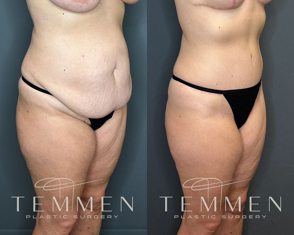 Before and after plastic surgery side view.