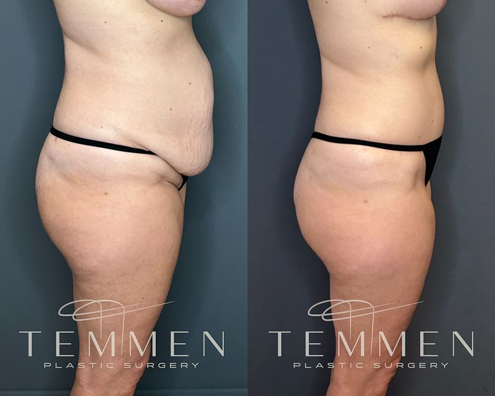 Before and after plastic surgery side view.