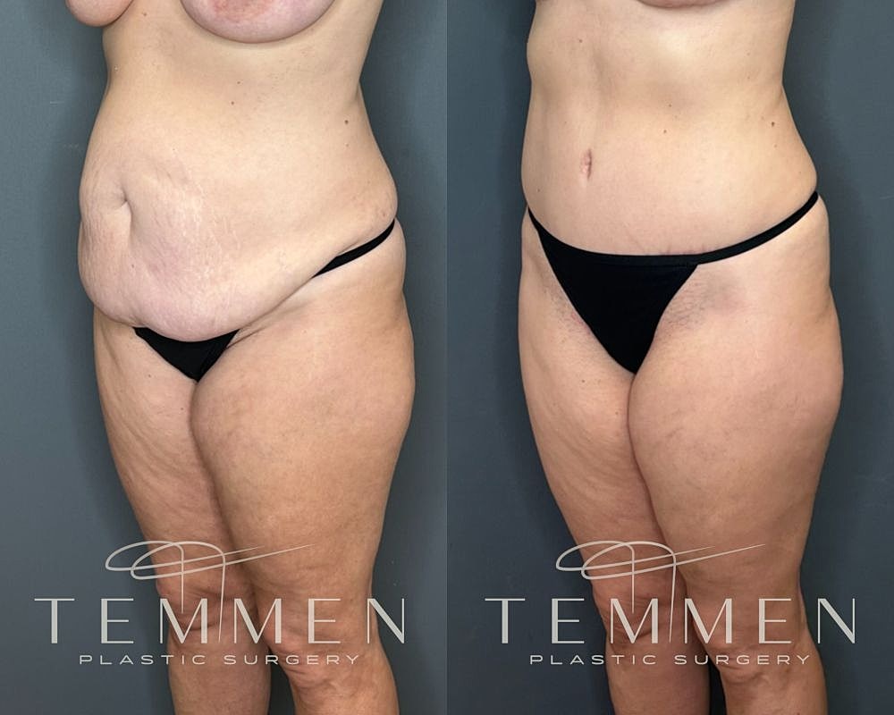 Before and after body contouring results.