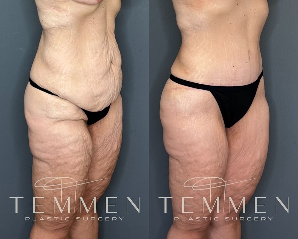 Tummy Tuck Before & After