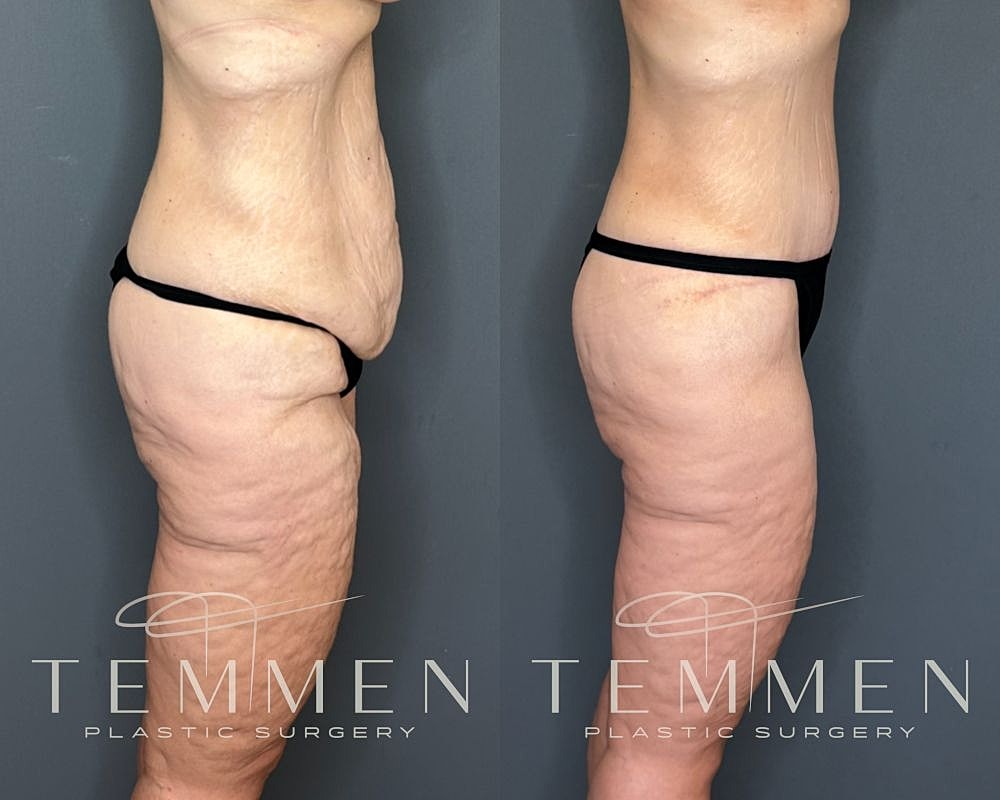 Tummy Tuck Before & After