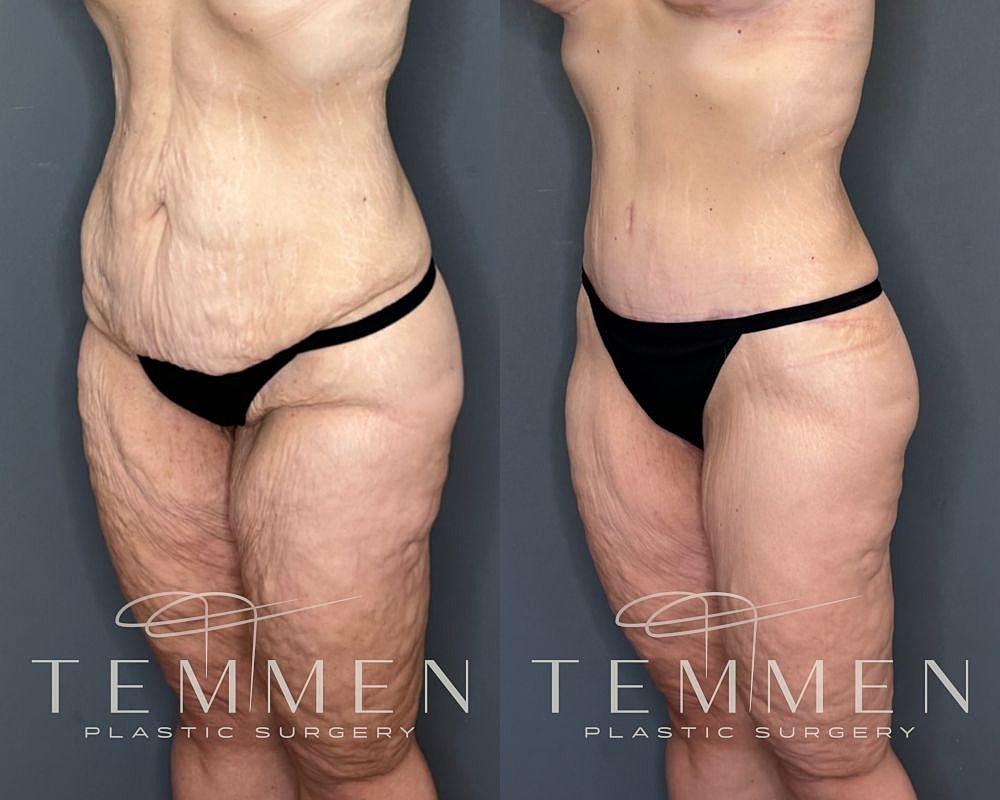 Tummy Tuck Before & After