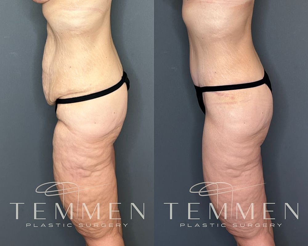 Tummy Tuck Before & After