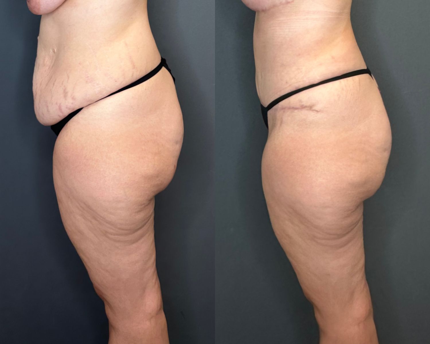 Tummy Tuck Before & After