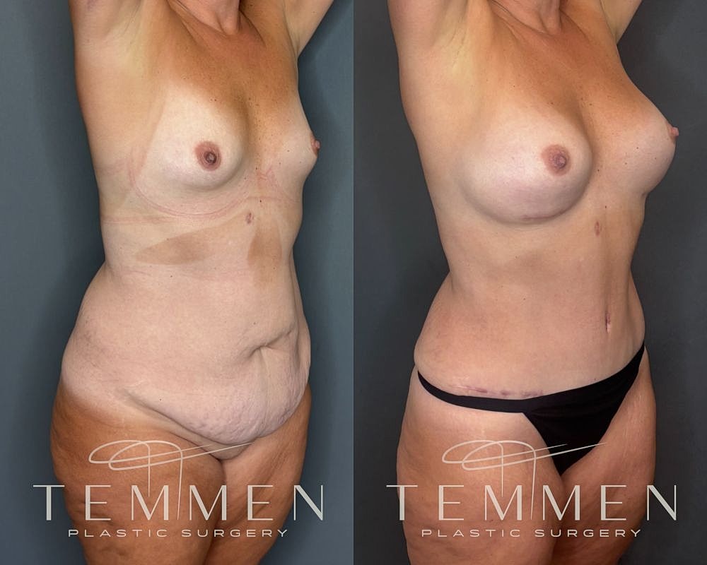 Before and after body contouring surgery results.