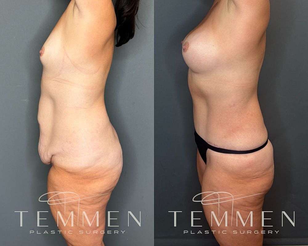Before and after plastic surgery transformation side view.