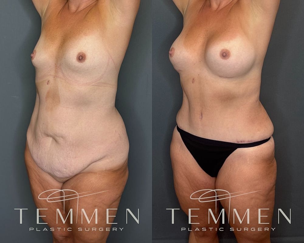 Before and after body contouring procedure photo.