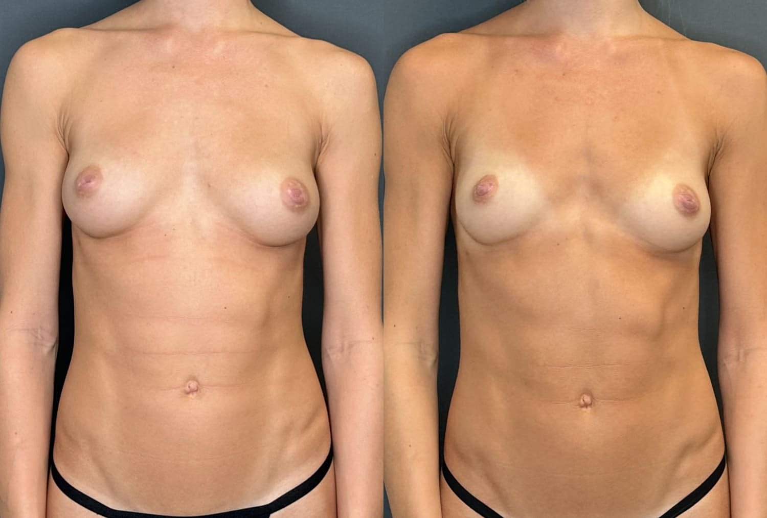 Nipple Inversion Correction Before & After