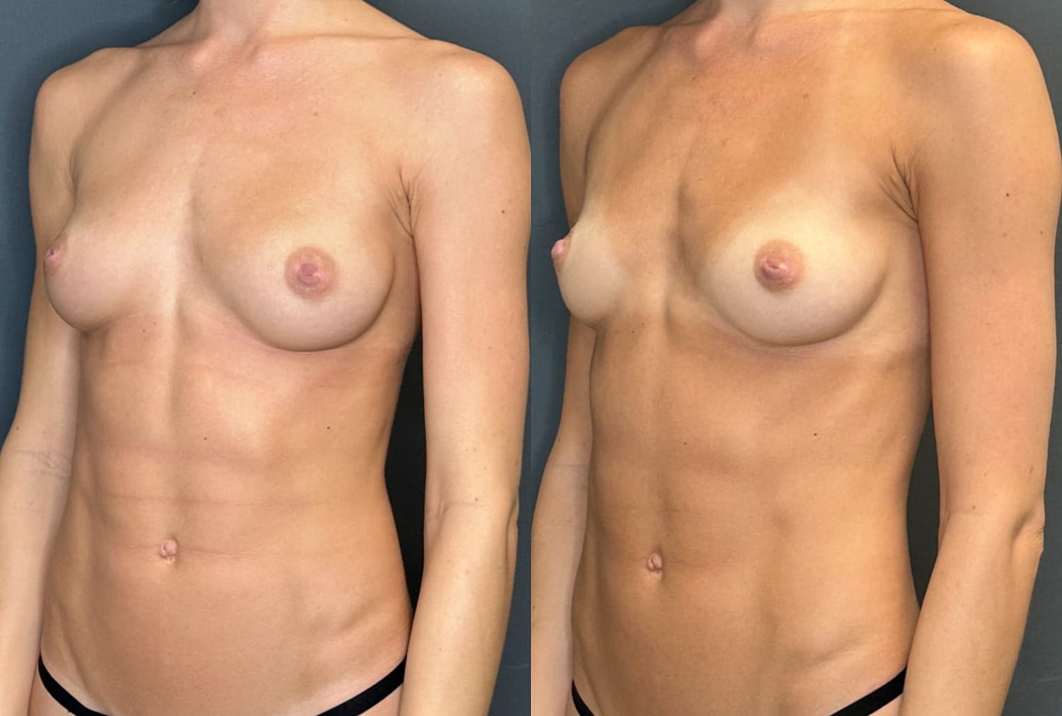 Nipple Inversion Correction Before & After
