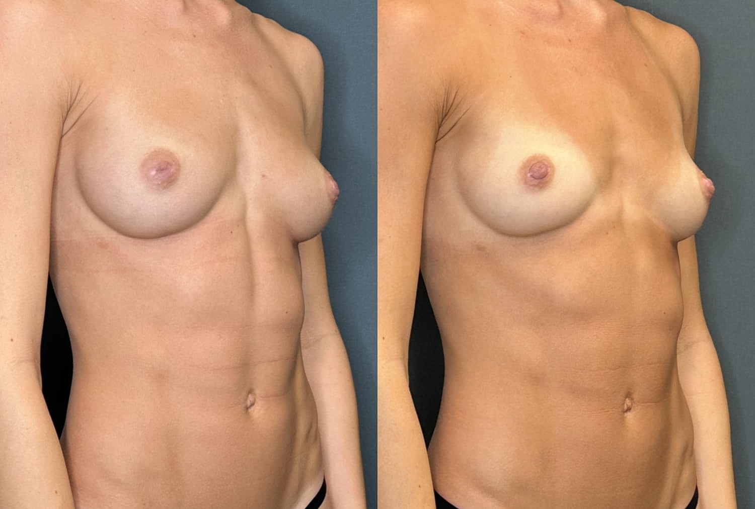 Nipple Inversion Correction Before & After