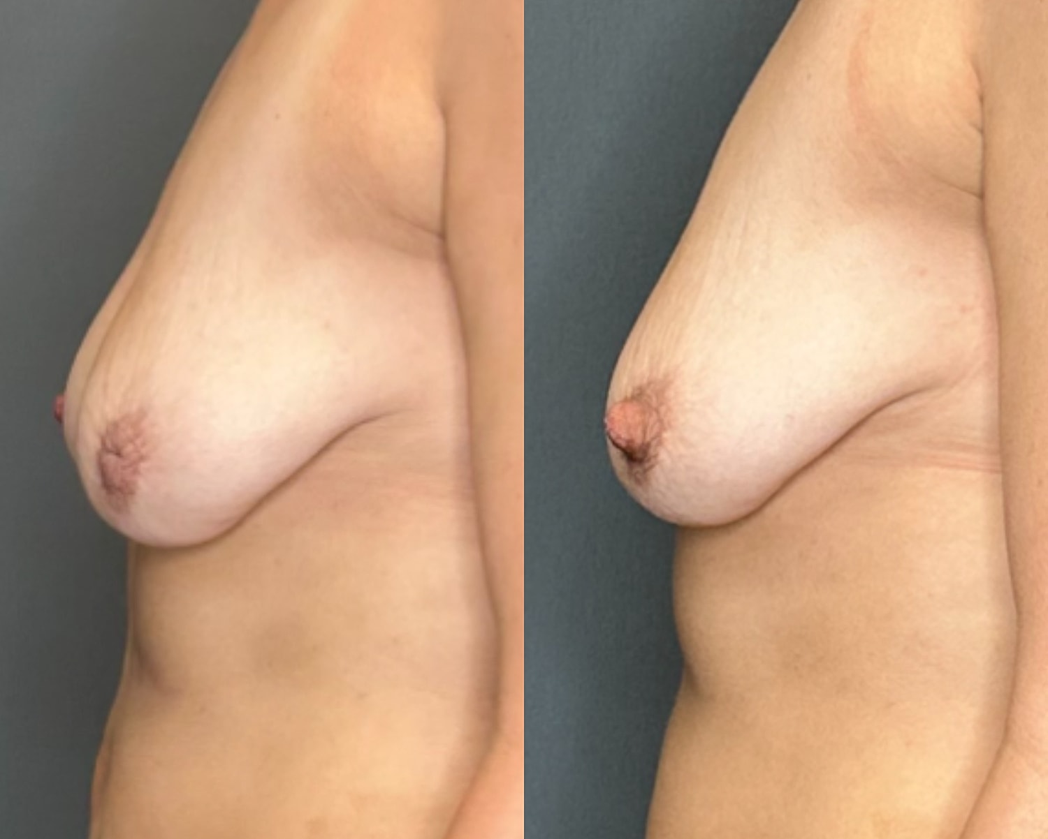 Nipple Inversion Correction Before & After