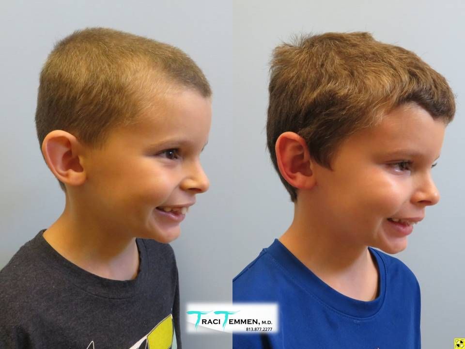 Ear Surgery Before & After