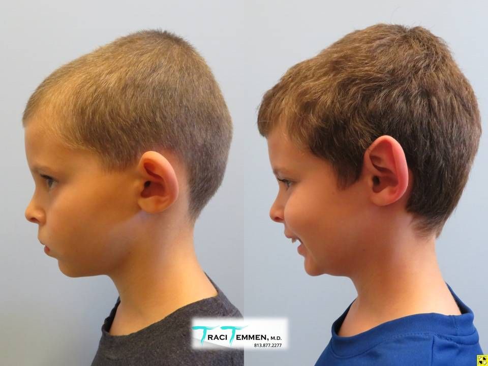 Ear Surgery Before & After
