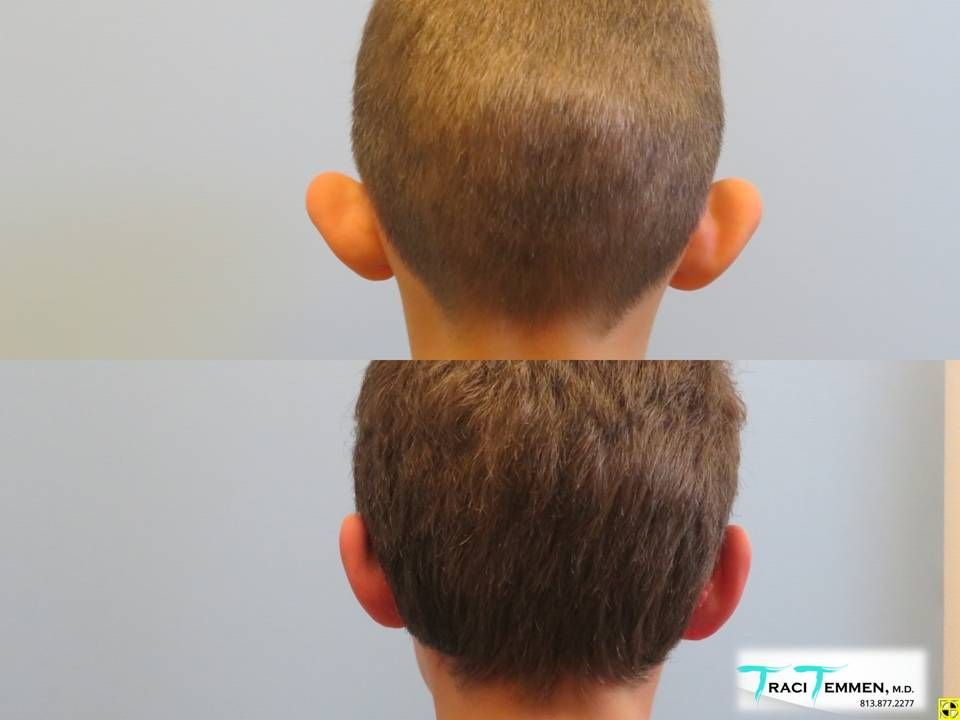 Ear Surgery Before & After