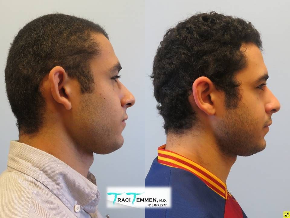 Ear Surgery Before & After