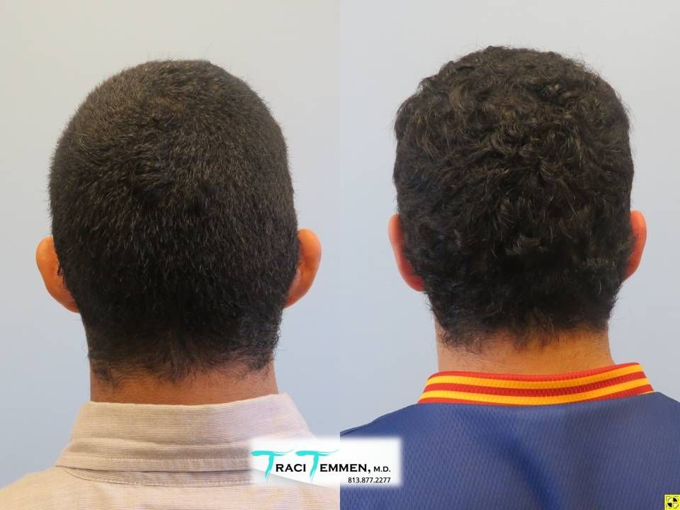 Ear Surgery Before & After