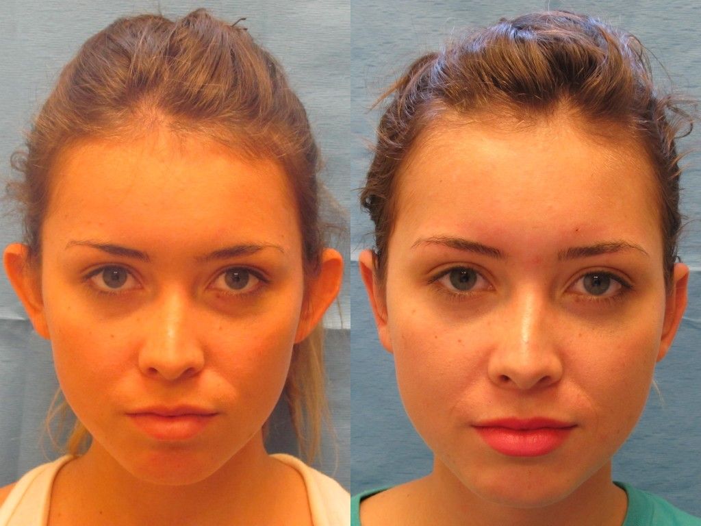 Ear Surgery Before & After