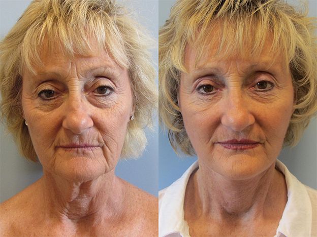 Face Fat Grafting Before & After