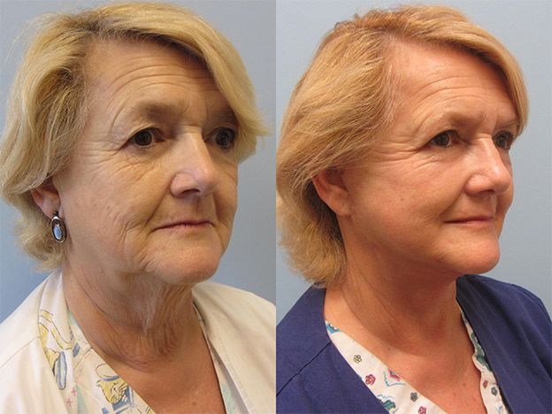Face Fat Grafting Before & After