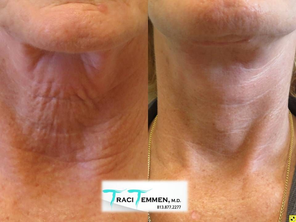 Face Fat Grafting Before & After