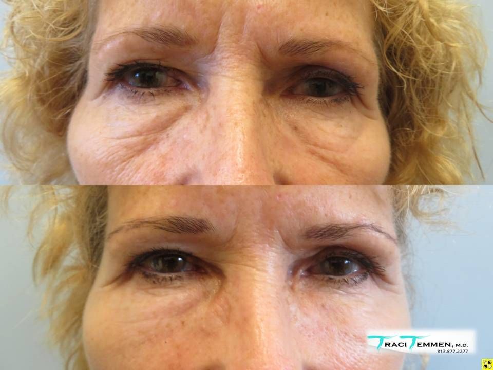 Face Fat Grafting Before & After
