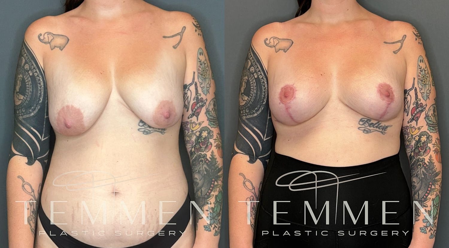 Breast Implant Revision With Lift Before & After