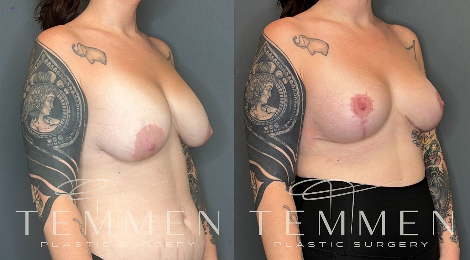 Breast Implant Revision With Lift Before & After