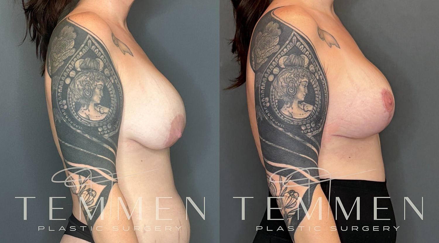 Breast Implant Revision With Lift Before & After
