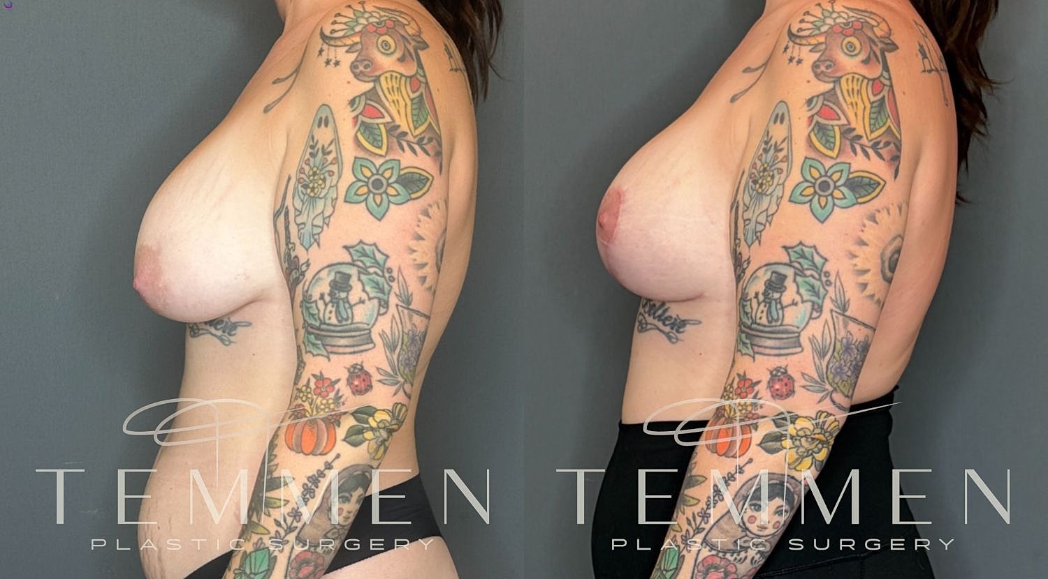 Breast Implant Revision With Lift Before & After