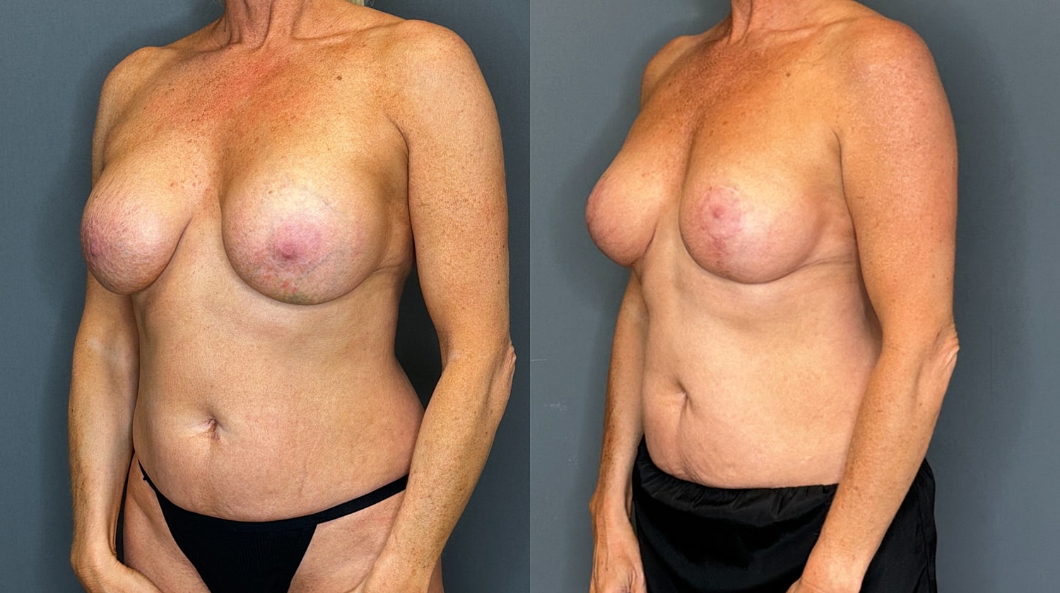 Breast Implant Revision With Lift Before & After