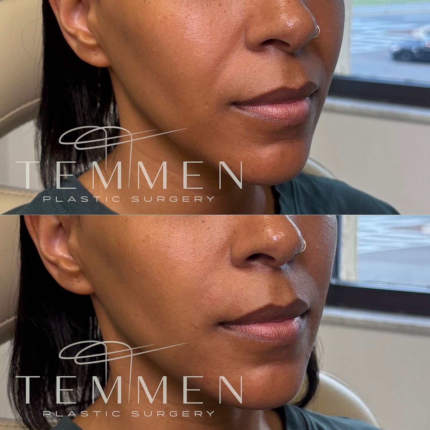 Nasolabial Fold Filler Before & After