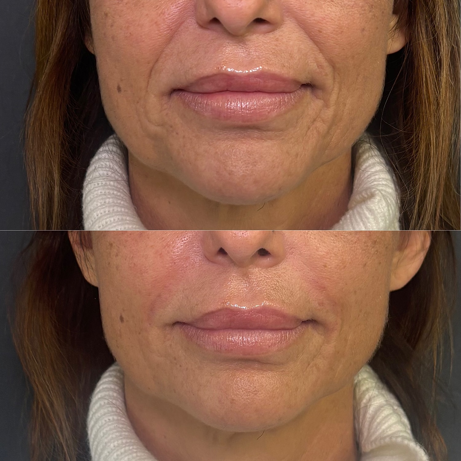 Nasolabial Fold Filler Before & After